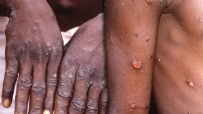 Եվրոպայում կապիկների ծաղիկ հիվանդության դեպքեր է գրանցվել