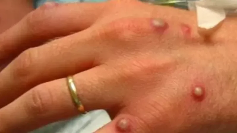 Կապկի ծաղիկի գրանցված դեպքերի թիվը 80 է. ԱՀԿ