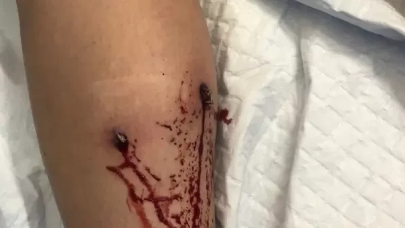 Կլինեմ շատ կարճ՝ չեք մարսելու․ Վանեցյանը հրապարակել է քաղաքացու` հատուկ միջոցից վնասված ոտքի լուսանկարը