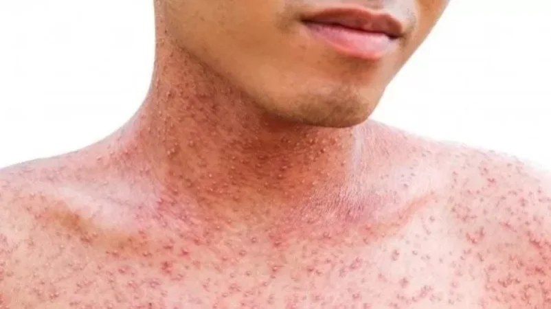 ՀՀ-ում կարմրուկի 11 դեպք է հայտնաբերվել. նախարարությունը հորդորում է