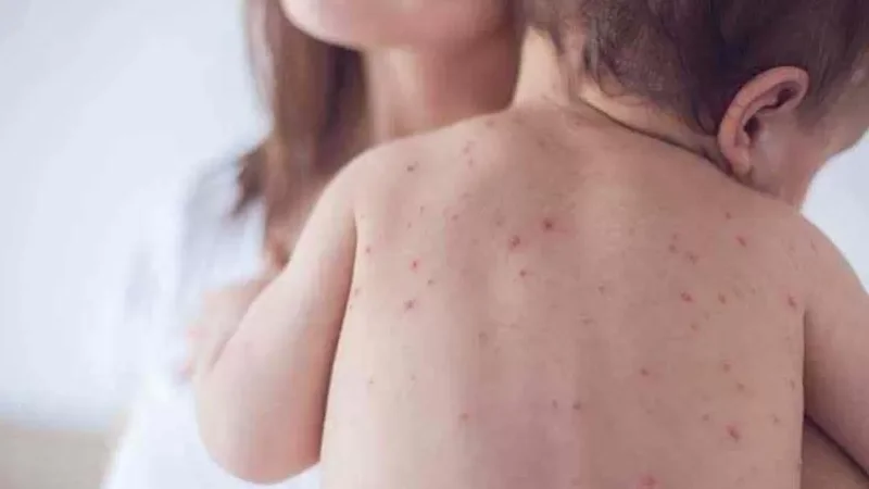 Կարմրուկի դեպքերի թիվը հասել է` 12-ի