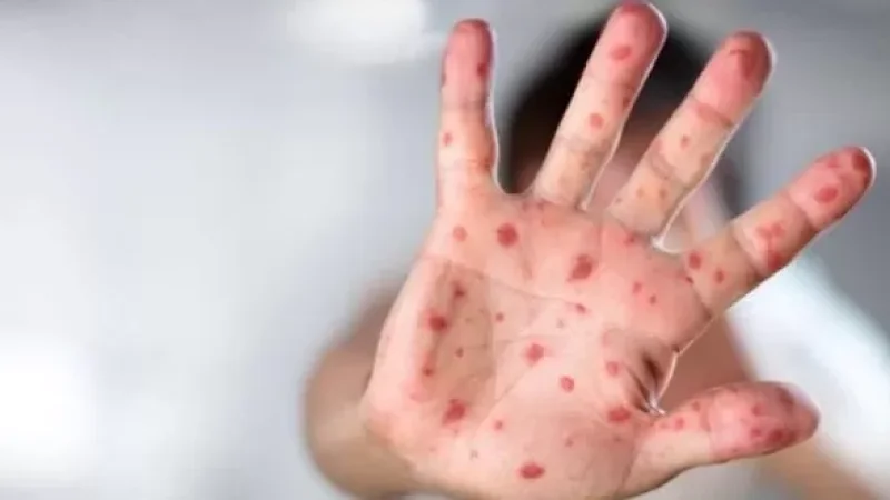 Մարտի 8-ի դրությամբ ՀՀ-ում կարմրուկի հաստատված դեպքերի թիվը հասել է 39-ի