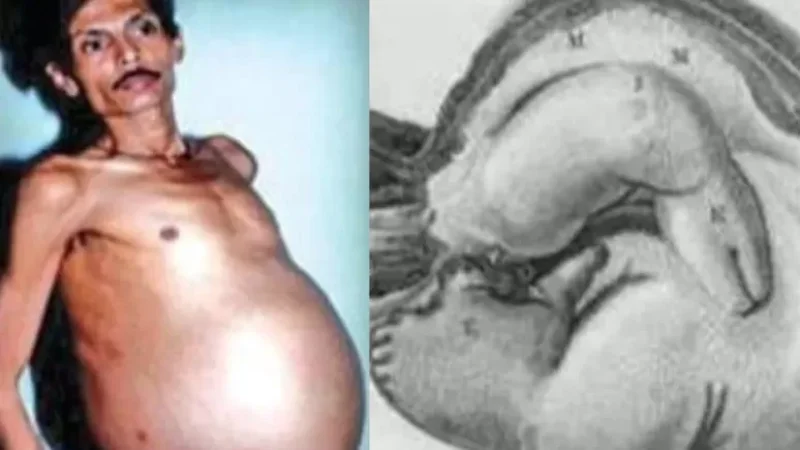 Հնդկաստանում տղամարդը 36 տարի որովայնում պահել է իր երկվորյակին․ նրան «հղի տղամարդ» են անվանել