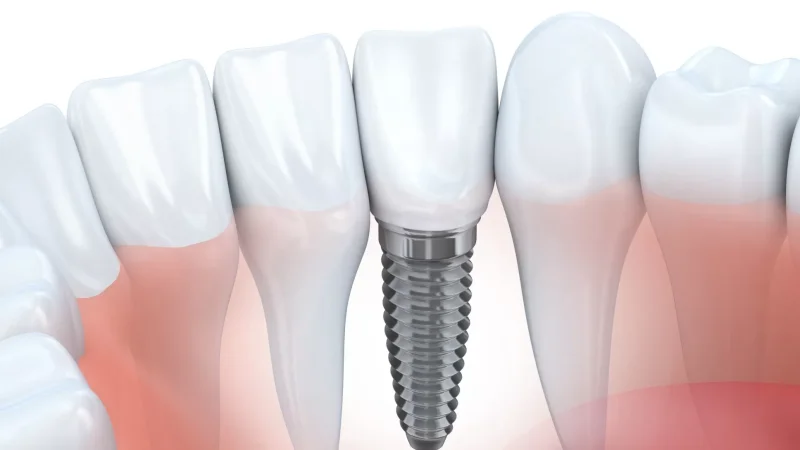 ՀՀ–ում թույլ չեն տա, որ պետպատվերի շրջանակում անորակ իմպլանտներ տեղադրվեն