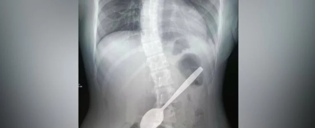 Աղջկա ստամոքսից 15 սմ երկարությամբ գդալ են հանել. ՌԴ