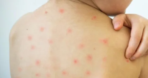 Ապատեղեկատվություն՝ ջրծաղիկի դեմ պատվաստանյութի վերաբերյալ. ՀՎԿԱԿ