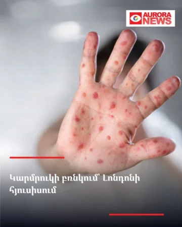 Կարմրուկի բռնկում՝ Լոնդոնի հյուսիսում