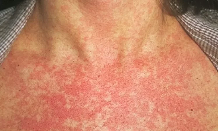 Արձանագրվել է կարմրուկի բերովի դեպք