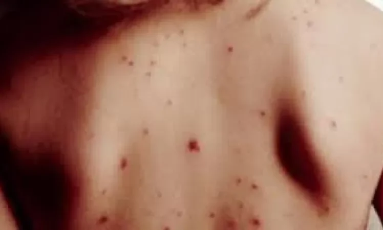 Հայաստանում կարմրուկի երրորդ դեպքն է արձանագրվել