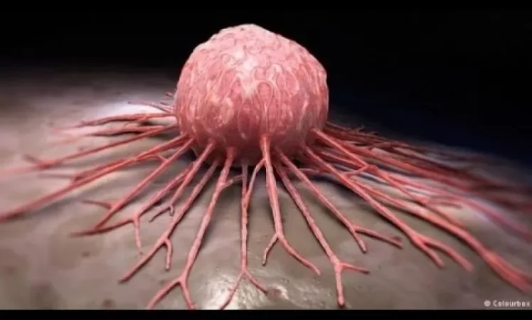 Հայաստանում  քաղցկեղից տարեկան մոտ 5600 մարդ է մահանում