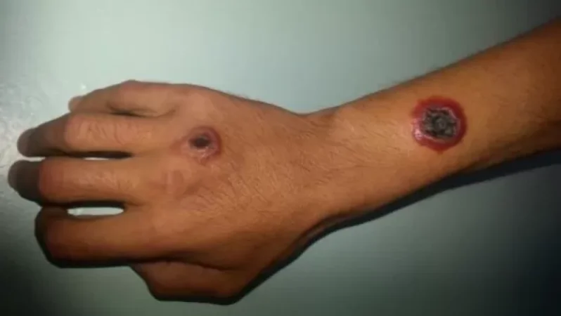 Սիբիրյան խոցի դեպք Գեղարքունիքի մարզում. 5 հոգի ուղեգրվել են «Նորք» ինֆեկցիոն հիվանդանոց. Առողջապահության նախարարություն