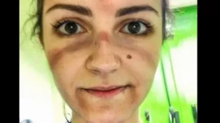 Կորոնավիրուսի դեմ պայքարի առաջնագծում. պայքարի հետքերը՝ բժիշկների դեմքին