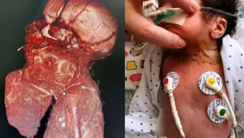 «Սուրբ Աստվածամայր» ԲԿ-ում բացառիկ վիրահատություն է արվել․ երեխան ծնվել է պարանոցին գլխից մեծ ուռուցքով