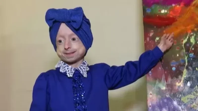 Photo: 10-Year-Old Child Dies from Rare Premature Aging in Ukraine