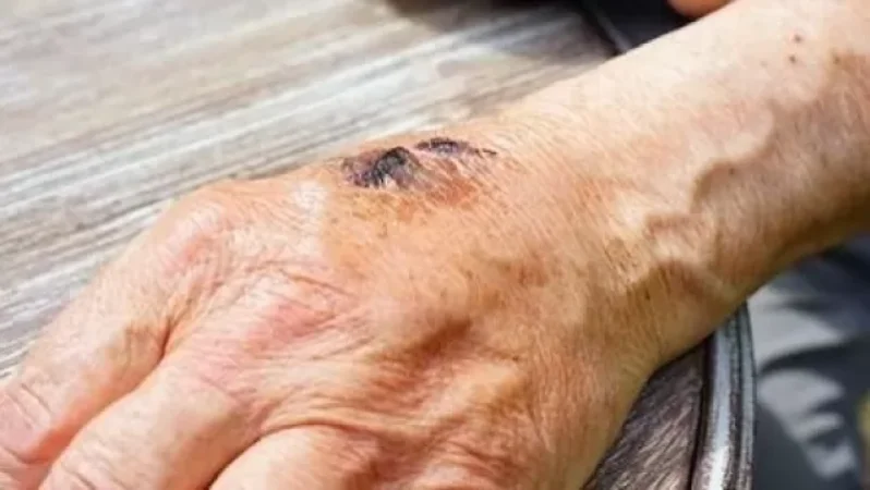 Շիրակի մարզի 5 բնակչի մոտ հաստատվել է «սիբիրյան խոց». ԱՆ-ն մանրամասնում է