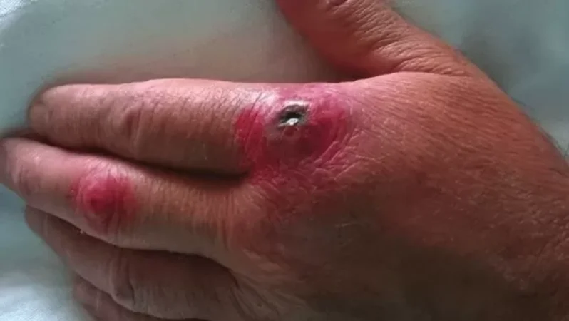 «Չենք կարող բացառել, որ կարձանագրվեն սիբիրյան խոցի դեպքեր». Վահե Դանիելյան