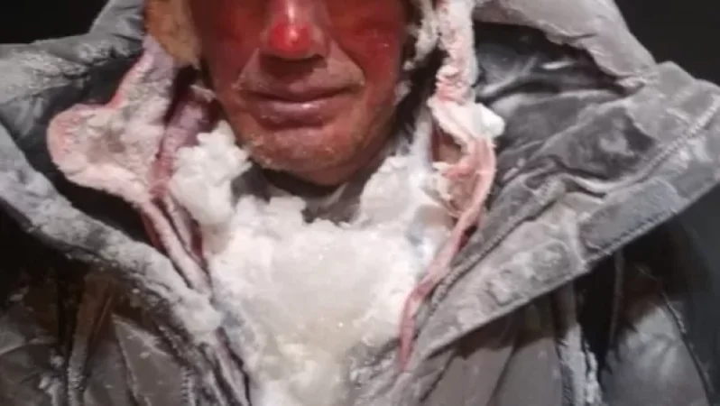 PHOTOS: This Is What Climbers Looked Like Right After Being Rescued (Not Recommended for the Faint of Heart)