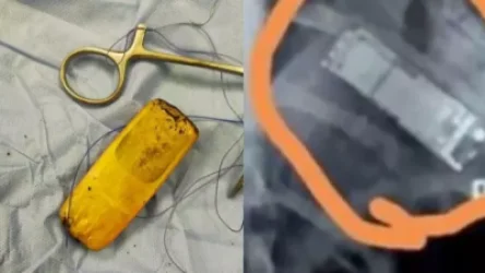 Եգիպտոսում վիրաբույժները տղամարդու օրգանիզմից  դուրս են բերել վեց ամիս առաջ կուլ տված հեռախոսը