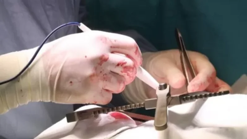 Ավստրիայում ձախի փոխարեն անդամահատել են պացիենտի աջ ոտքը