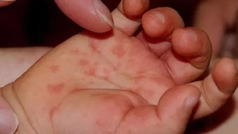 Հայաստանում արձանագրվել է լաբորատոր հաստատված կարմրուկի դեպք