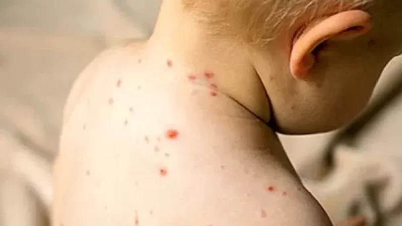 Մանկապարտեզներում և դպրոցներում ջրծաղիկի դեպքեր են գրանցվում. ծնողներն ահազանգում են