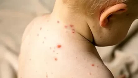 Մանկապարտեզներում և դպրոցներում ջրծաղիկի դեպքեր են գրանցվում. ծնողներն ահազանգում են