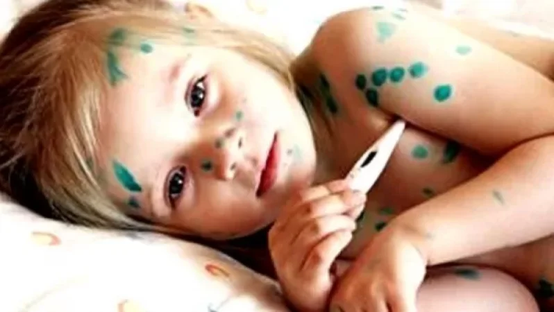 ՀՀ- ում ջրծաղիկի հիվանդացության ցուցանիշը չի հատում վարակի սեզոնայնությանը բնորոշ շեմը. ՀՀ ԱՆ