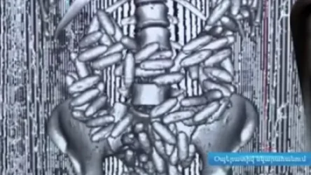 ՏԵՍԱՆՅՈՒԹ. ՀՀ ժամանած ուղևորի աղիներում 300 հազար դոլարի 120 պարկուճ կոկաին են հայտնաբերել