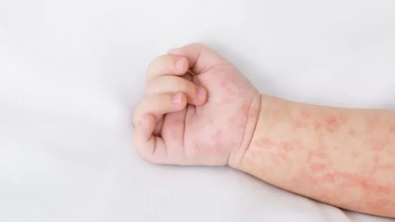 Մանրամասներ՝ կարմրուկից մահացած երեխայի մասին