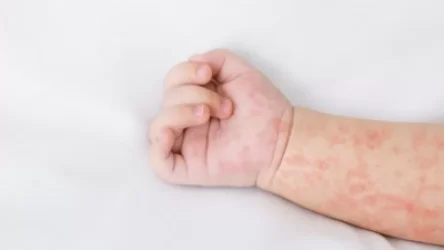 Մանրամասներ՝ կարմրուկից մահացած երեխայի մասին