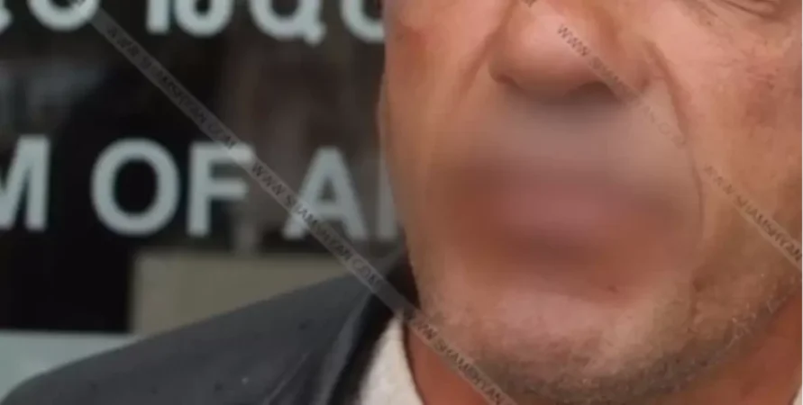 Վանաձորի բանտում դատապարտյալը կարել է շուրթերը, ապա գնդասեղով միացրել իրար