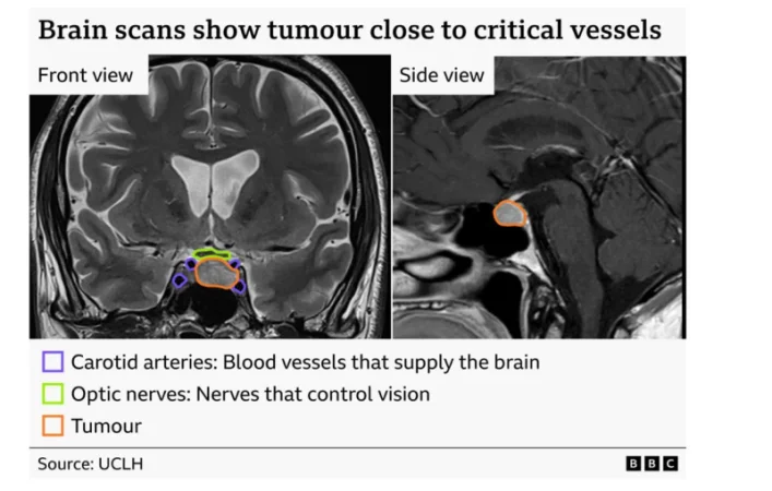 First Brain Surgery Performed with AI Assistance in Britain