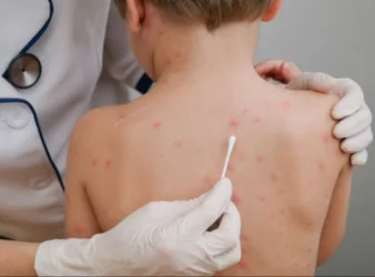 Նախարարը՝ ջրծաղիկով վարակված երեխայի մահվան դեպքի մասին