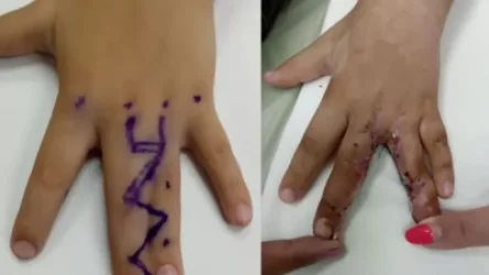 Վերականգնվել է 5-ամյա փոքրիկի մատների շարժունակությունը