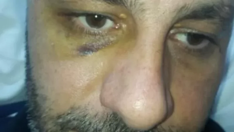Severe Beating of 47-Year-Old Syrian-Armenian in Yerevan Over Parking Dispute