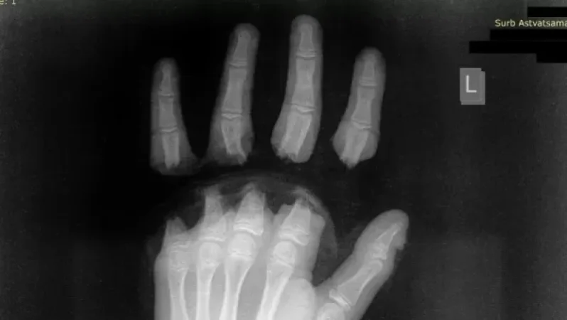 12 տարեկան երեխան չորս մատները կտրված վիճակում տեղափոխվել է հիվանդանոց. Գևորգ Դերձյան