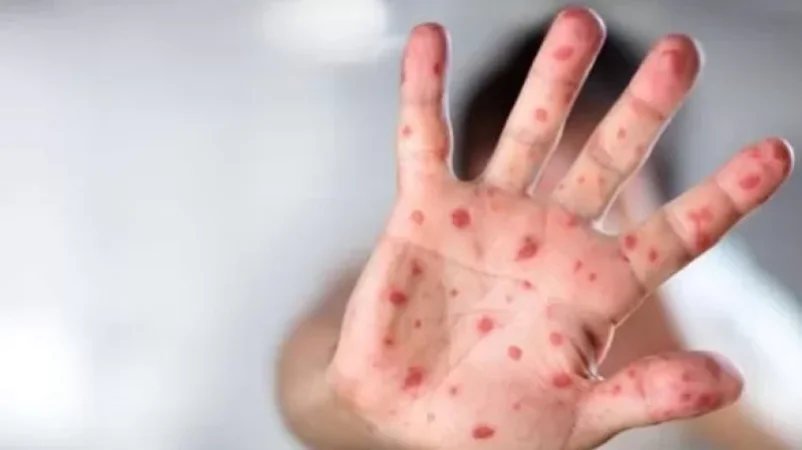 Կարմրուկի հաստատված դեպքերի թիվը հասել է 29-ի