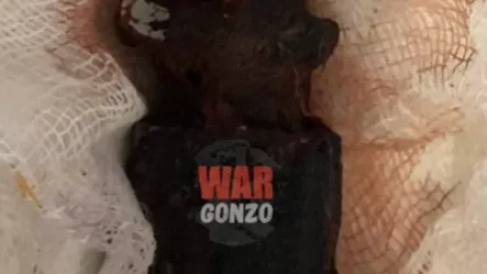 Արցախում բժիշկները 5 սմ-ին հասնող խոցող տարրեր են հանում քաղաքացիների մարմիններից