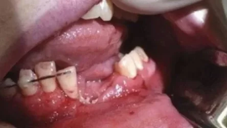 էլեկտրոնային ծխախոտը պայթել է՝ վնասելով դեռահասի ծնոտը