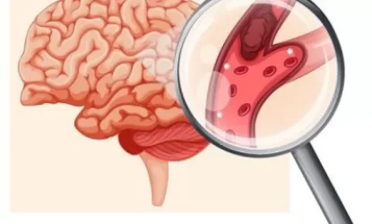 Գլխուղեղի իշեմիկ սուր կաթվածի բուժման ծրագրի շրջանակում առաջին պացիենտն է բուժվել. նախարար