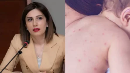 Դեռ կարմրուկի լոկալ բռնկման շրջանակից դուրս չենք եկել․ Ավանեսյան