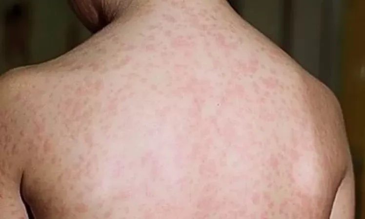 Կիևից ՀՀ եկած քաղաքացու մոտ կարմրուկ է հայտնաբերվել.ԱՆ-ն հորդորում է թռիչքի ուղևորներին պատվաստվել