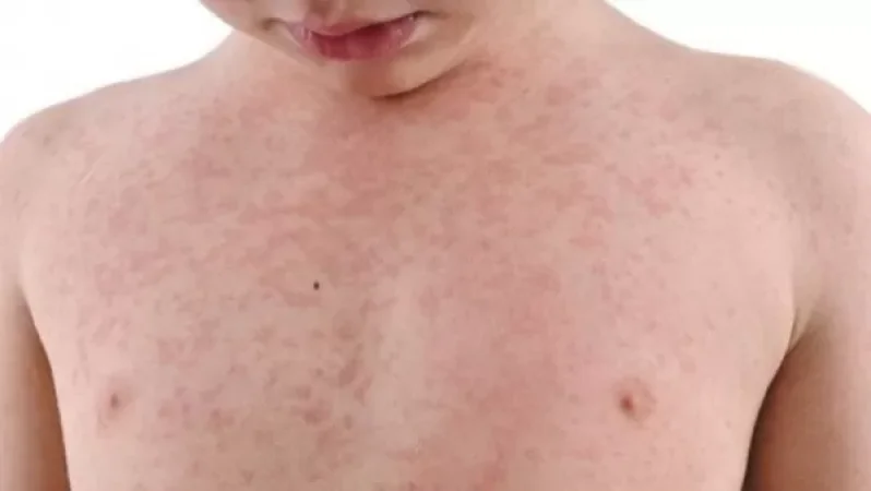 Հայաստանում արձանագրվել է կարմրուկի բերովի դեպք