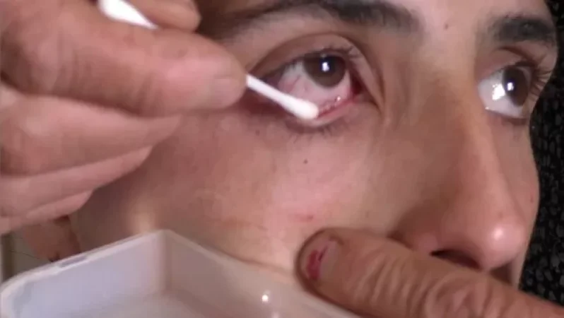 «Բյուրեղյա» արցունքներ ունեցող աղջկա մասին մանրամասնում է ակնաբույժը