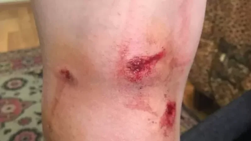 Երևանի դպրոցներից մեկի մոտ շները հարձակվել են 17-ամյա աղջկա վրա, ով պարապմունքից տուն գնալիս է եղել. ArmDaily