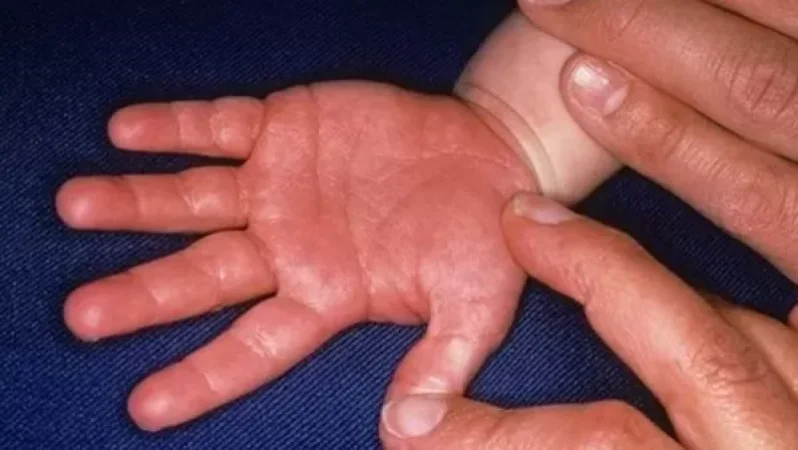 Հայաստանում կավասակիի սինդրոմի 2-րդ դեպքն է գրանցվել. ԱՆ խոսնակ