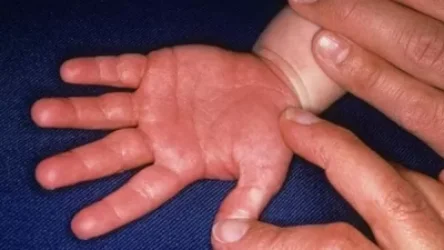 Հայաստանում կավասակիի սինդրոմի 2-րդ դեպքն է գրանցվել. ԱՆ խոսնակ