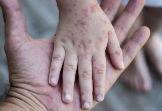 Եվրոպայում բարձրացվել է «կապիկի ծաղկով» վարակման ռիսկի մակարդակը