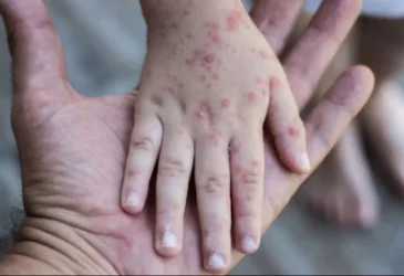 Եվրոպայում բարձրացվել է «կապիկի ծաղկով» վարակման ռիսկի մակարդակը