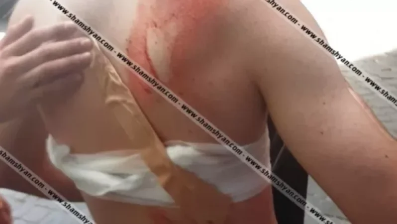 Դանակահարություն Երևանի խամաճիկների թատրոնի մոտ․ 18-ամյա տղան վիրավոր է